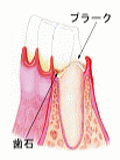 初期の歯周病
